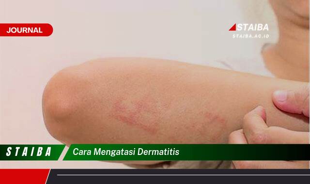 Ketahui Cara Mengatasi Dermatitis Secara Efektif dan Alami Ketahui Cara Mengatasi Dermatitis Secara Efektif dan Alami