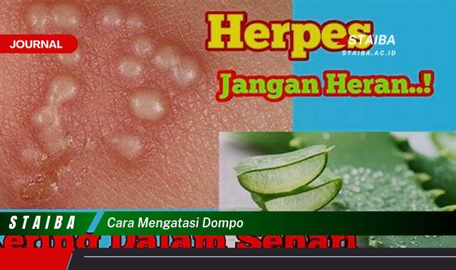 Ketahui Cara Mengatasi Dompo Secara Efektif dan Alami di Rumah Ketahui Cara Mengatasi Dompo Secara Efektif dan Alami di Rumah
