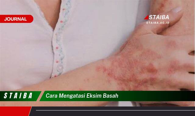 Ketahui Cara Mengatasi Eksim Basah dengan Cepat dan Efektif untuk Kulit Lembap dan Nyaman
