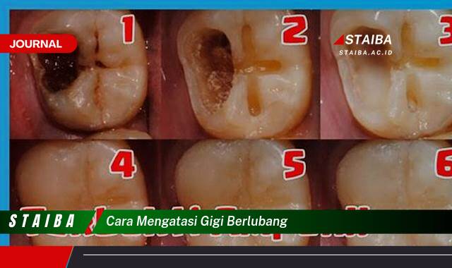 Ketahui Cara Mengatasi Gigi Berlubang, Panduan Lengkap Pencegahan dan Perawatan di Rumah