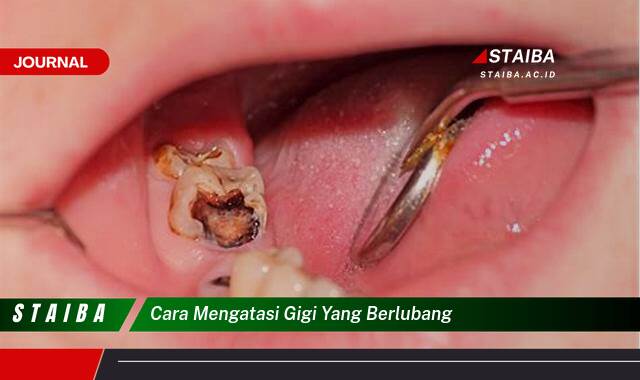Ketahui Cara Mengatasi Gigi Berlubang Secara Alami dan Medis