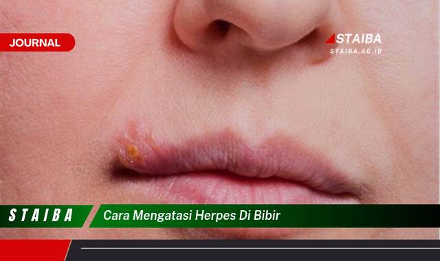 Ketahui Cara Mengatasi Herpes di Bibir dengan Cepat dan Efektif Ketahui Cara Mengatasi Herpes di Bibir dengan Cepat dan Efektif