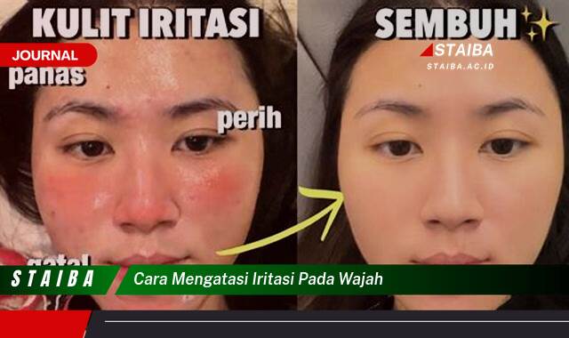 Ketahui Cara Mengatasi Iritasi Pada Wajah Dengan Cepat dan Alami