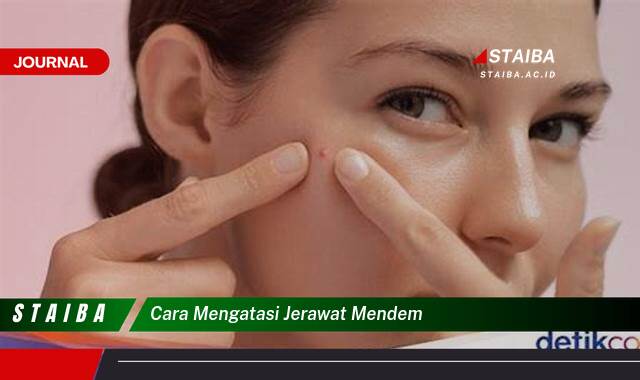 Ketahui Cara Mengatasi Jerawat Menden dengan Cepat dan Ampuh