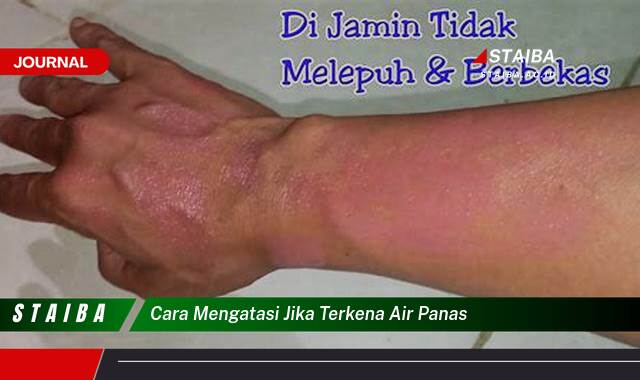Ketahui Cara Mengatasi Luka Bakar Akibat Air Panas, Pertolongan Pertama dan Pengobatan Rumahan