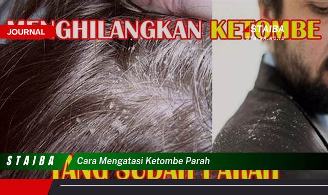 Ketahui Cara Mengatasi Ketombe Parah dengan Cepat dan Ampuh