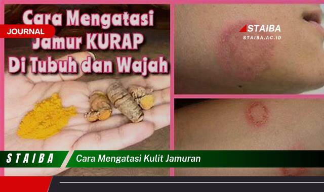 Ketahui Cara Mengatasi Kulit Jamuran Secara Efektif dan Alami