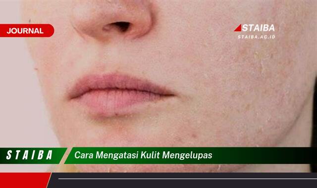Ketahui Cara Mengatasi Kulit Mengelupas, Penyebab dan Solusinya Ketahui Cara Mengatasi Kulit Mengelupas, Penyebab dan Solusinya