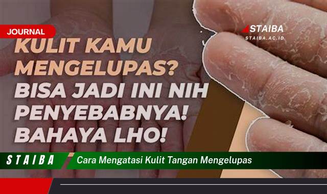 Ketahui Cara Mengatasi Kulit Tangan Mengelupas Secara Alami dan Efektif Ketahui Cara Mengatasi Kulit Tangan Mengelupas Secara Alami dan Efektif
