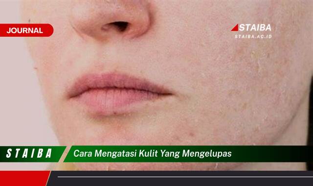 Ketahui Cara Mengatasi Kulit yang Mengelupas, Penyebab dan Solusinya Ketahui Cara Mengatasi Kulit yang Mengelupas, Penyebab dan Solusinya