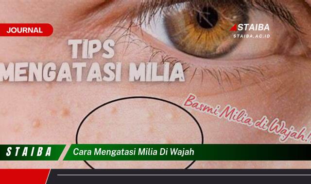 Ketahui Cara Mengatasi Milia di Wajah Secara Efektif dan Alami
