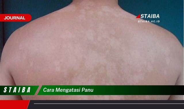 Ketahui Cara Mengatasi Panu Secara Alami dan Efektif