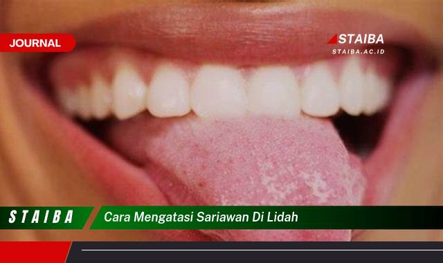 Ketahui Cara Mengatasi Sariawan di Lidah Secara Ampuh dan Alami