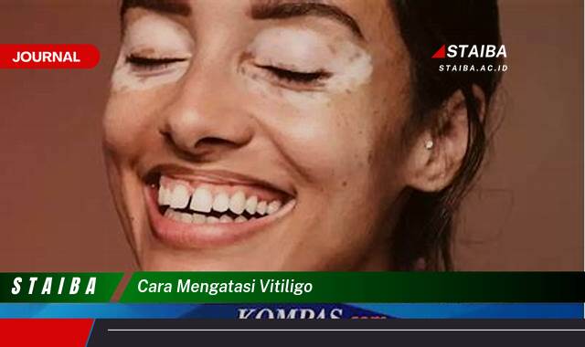 Ketahui Cara Mengatasi Vitiligo Secara Efektif dan Alami